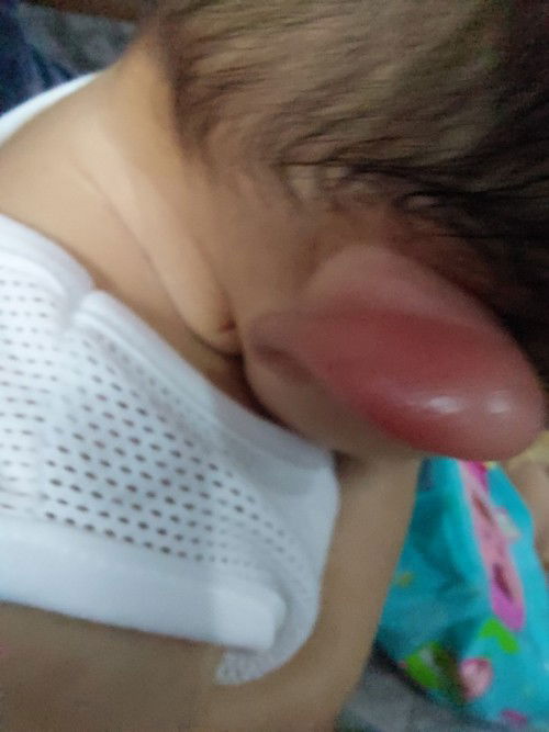 Swollen red right ear ni lo