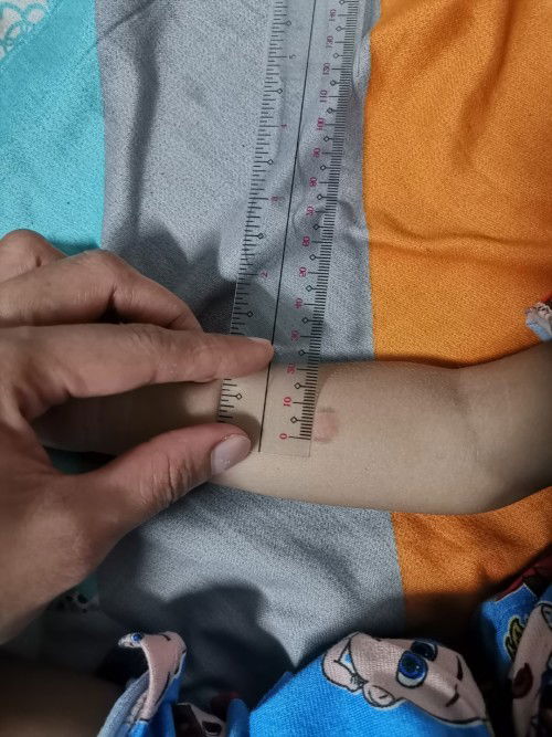 Tuberculin skintest.