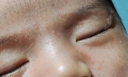 Rashes po ba eto? Ano po yung dahilan bakit my ganito? 20 days old si baby