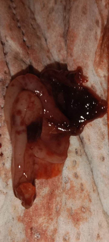 มันคือก้อนเลือดหรือแท้งคะ