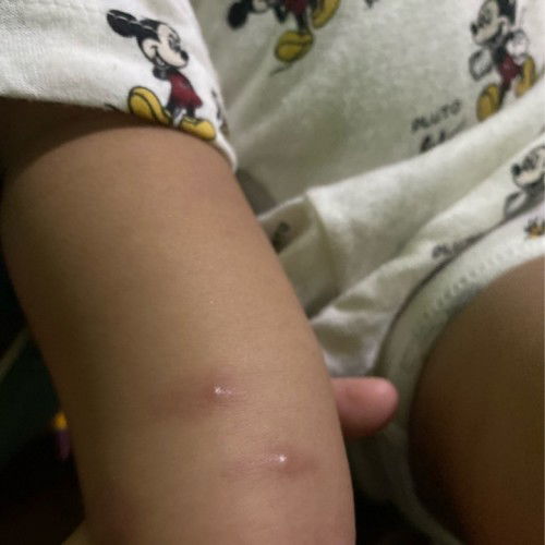 Menghilangkan bekas gigitan serangga