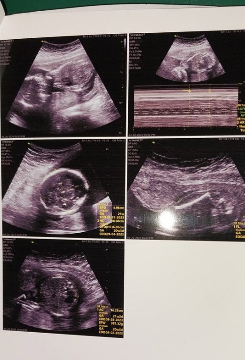 Ultrasound gender