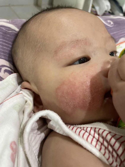 pipi merah2 pada bayi