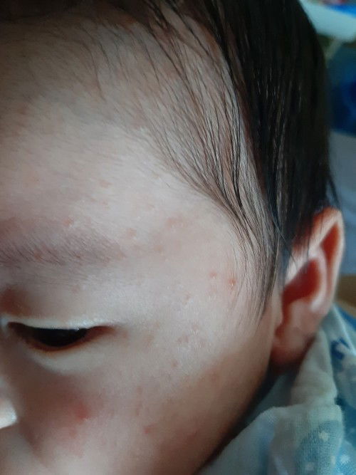 ผื่นแบบนี้ปกติใช่มั้ยคะ