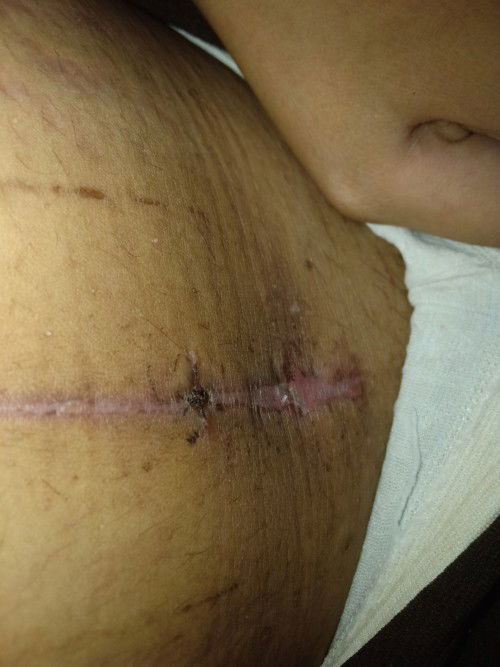 Bund ada yg sama ga luka habis sc nya seperti ini? Kira kira normal apa tidak?