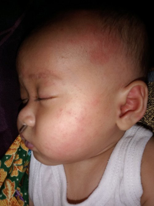 Beruntusan di muka bayi