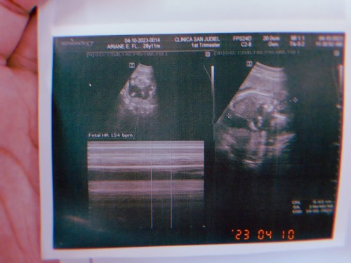 Hi mga mommy. 14weeks na c baby and 154bpm po syaa. Sa tingin nyo po, boy or girl po sya? Thankyou🫶
