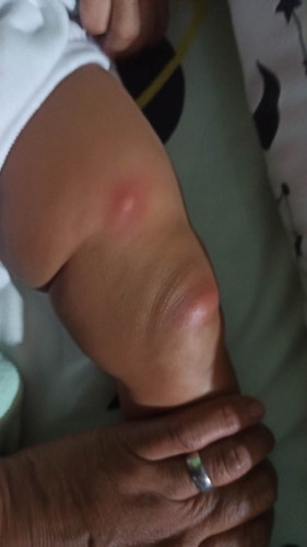Ano po ang kumagat sa baby ko? Naka pajama naman sya tapos paghubad, may kagat na.wala yan kagabi