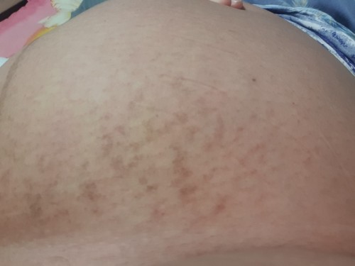 ใช่รอยแตกลายมั๊ยคะ?