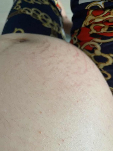 RASHES & STRETCHMARKS