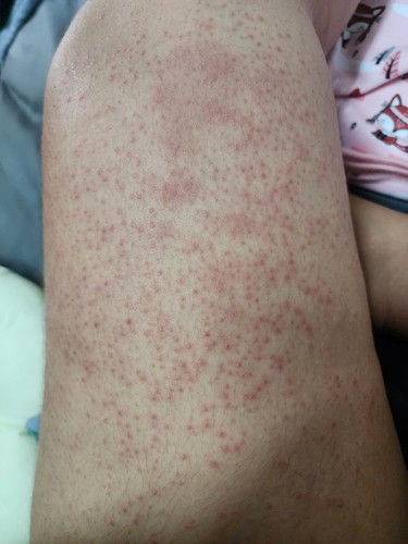 ผื่นแดงคันหลังคลอด