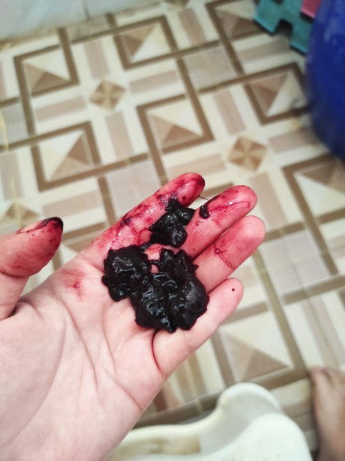 Nifas operasi sesar dan darah mati