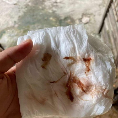 มีมูกเลือดต้องไปหาหมอเลยไหมค่ะ