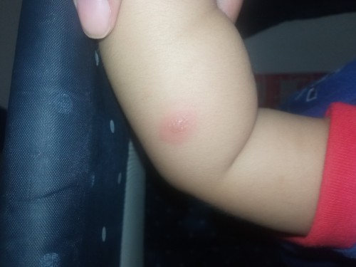 Insect Bite