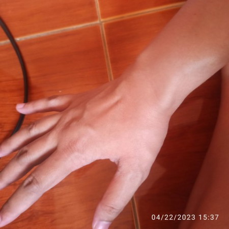 Masakit na ugat sa kamay sa ilalim ng thumb