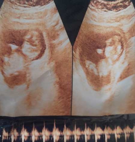 Các mom cho e hỏi với ạ. Ăn sữa chua thì ntn cho hợp lí ạ. Vì e tìm hiểu có nên hạn chế ấy ạ 😊