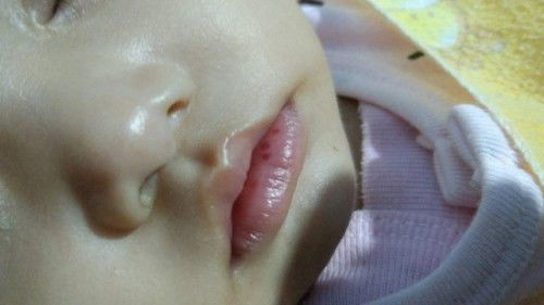 Bercak merah bayi 5 bulan