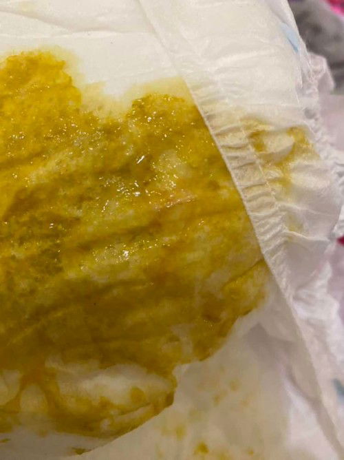 Semburat merah di BAB anak 4 bln