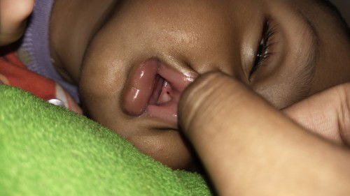 Merah merah di bibir atas