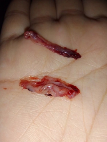 เเบบนี้คืออะไรคะเเท้งรึป่าวอยู่ๆก็เป็นถุงหลุดออกมา