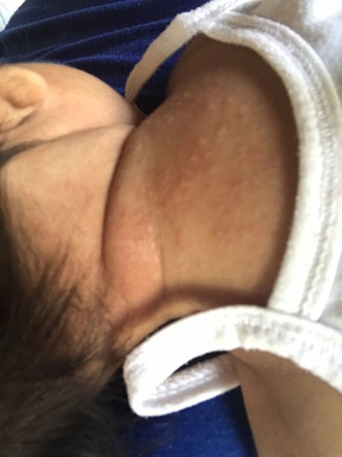 body rashes dahil sa init