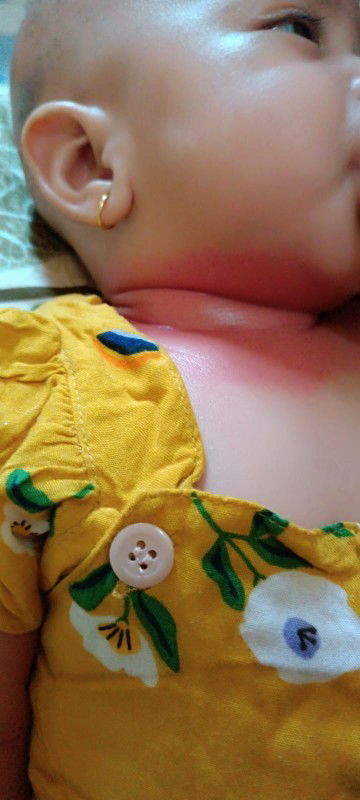 leher merah akibat minyak telon