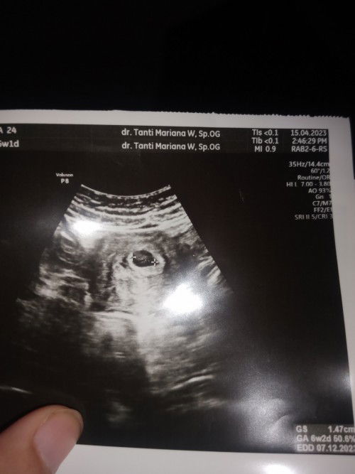 Hasil usg 6 minggu dan 7 minggu