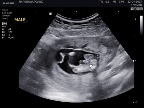 ซาวด์เพศลูก 14w+2 แบบนี้ชัดหรือยังคะ
อยากเริ่มซื้อของเตรียมให้น้องแล้วค่ะ🥰