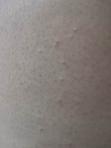 Rashes on legs part