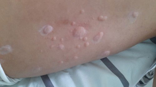 Apakah gatal-gatal alergi?