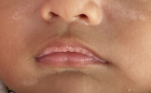 Puti puti sa mukha ni LO