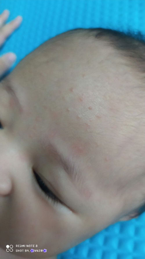 ruam atau apa di muka baby