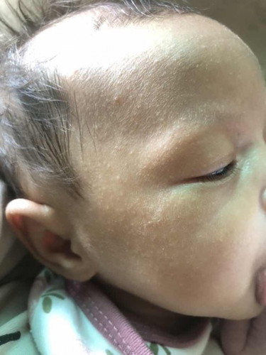 ผดแบบนี้ทำอะไรถึงหายค่ะแม่ๆแนะนำทีค่ะ