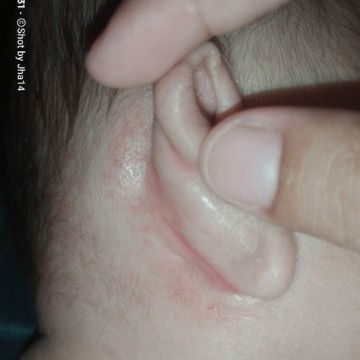 pwedeng gamot sa namumula at nagsusugat na tenga ng baby ..