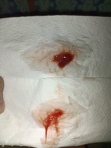DISCHARGE After e I.E