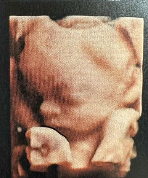 อายุครรภ์ 26w3d น้องน้ำหนักเท่าไหร่กันบ้างคะ