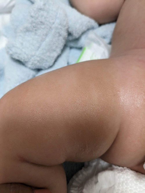 Baby’s skin concern