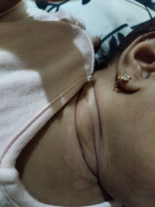 Mau tanya Bun, anak saya kan lehernya pernah merah2 gitu ya... Trs ini bekas nya ko jd putih?