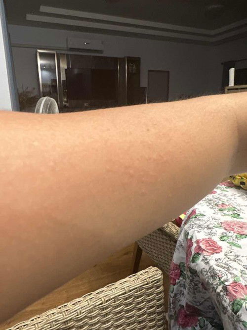 อาการคัน ตามร่างกาย