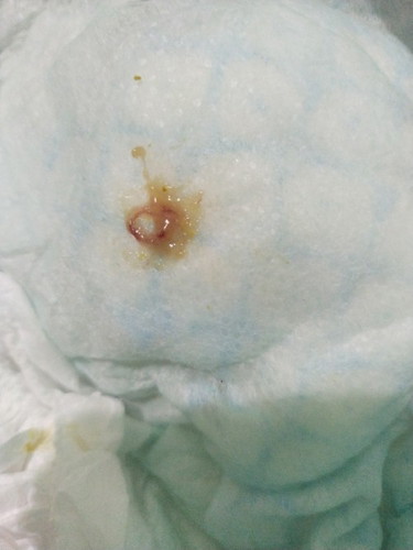 Normal lang ba Yung parang may konting dugo sa poop ni baby?