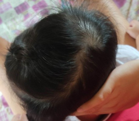 PLAGIOCEPHALY