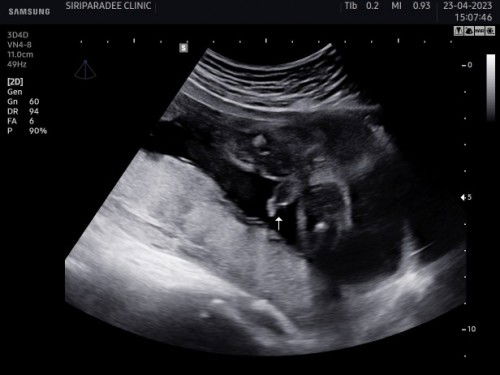 อัลตร้าซาวด์เพศลูก