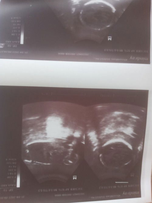 24 week ญ หลือ ช.แม่ๆช่วยดูหน่อยค่ะป้าหมอบอกชายแต่แม่ดูไม่ออกเลยค่ะ