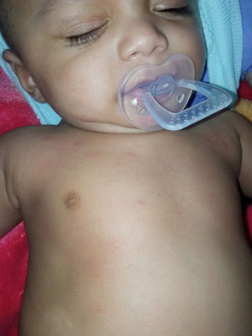 Bintik bintik merah pada bayi