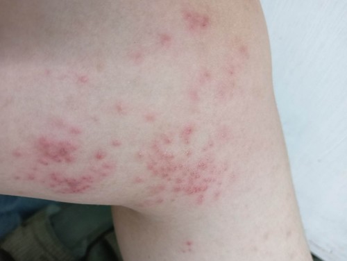 BUTLIG BUTLIG/RASHES. 6MONTHS PREGNANT