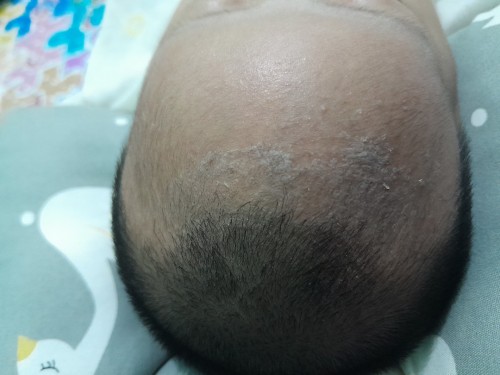 Kerak kepala bayi