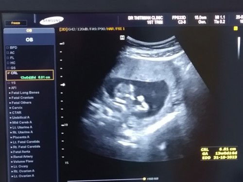 อายุครรภ์12สัปดาห์