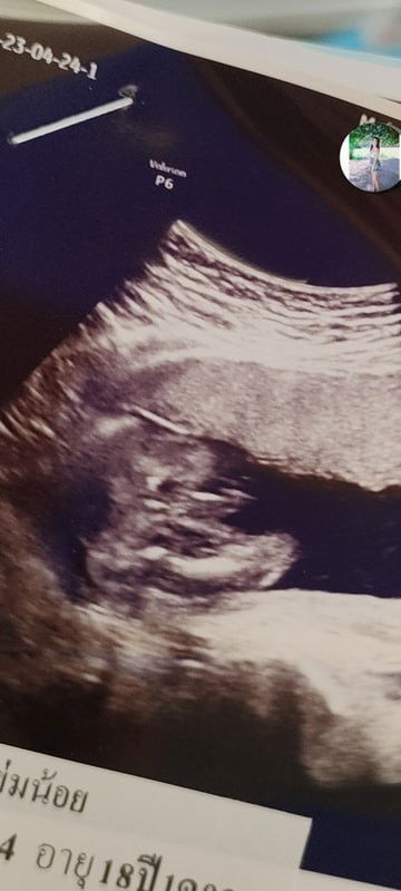 รบกวนเเม่ๆช่วยดูหน่อยค่ะ หมอบอกผู้ชาย 80% 
แม่บ้านนี้เสียวคลอดออกมาเป็นผู้หญิง🤣🤣