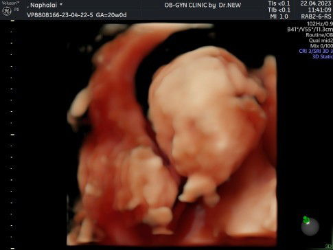 20 สัปดาห์ แม่ๆบ้านไหนเห็นใบหน้าน้องแล้วบ้างคะ