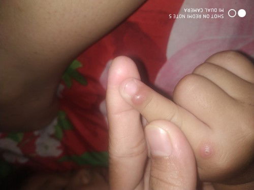 Ad yg tau gak ya ini kira2 kena ap? Ini bkn diggit semut atau nyamuk, kya bisul tp kya bkn 😞